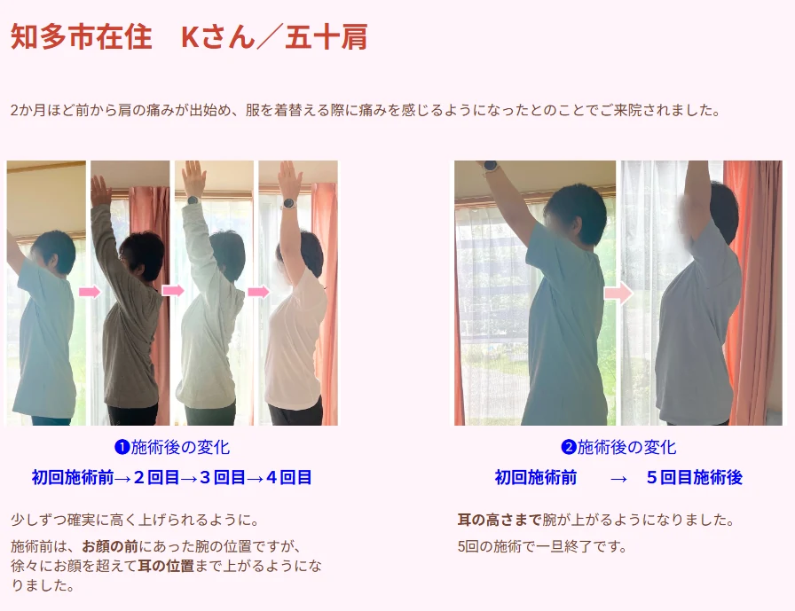五十肩の症例